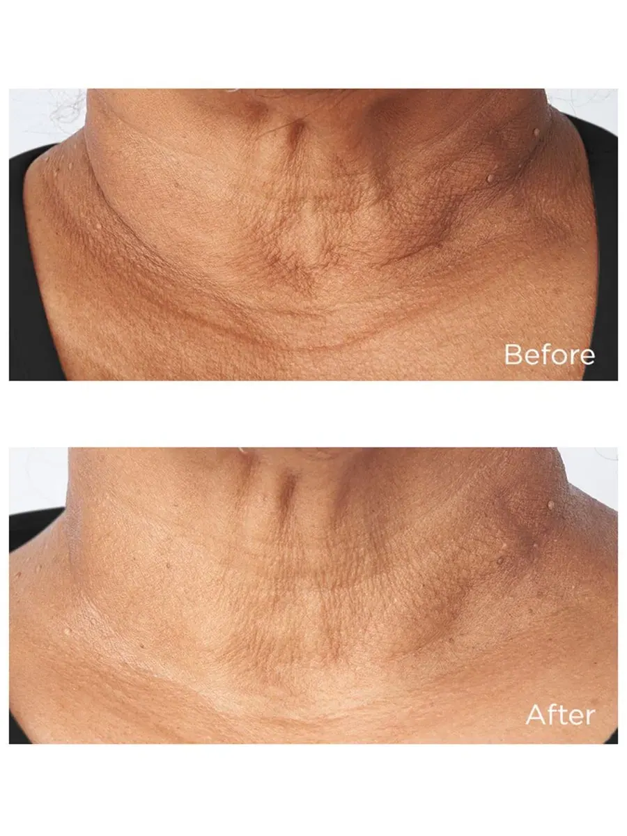 Крем для шеи и подбородка Cold Plasma Plus+ Sub-D/Neck, 59 мл Perricone MD — изображение 5 из 7