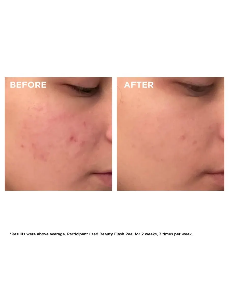 Пилинг Clarins — Экспресс- Beauty Flash Peel с BHA и AHA кислотами — изображение 5 из 7
