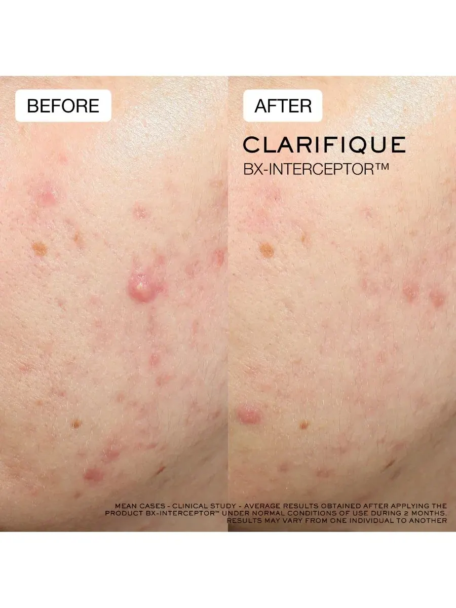 Сыворотка против акне Clarifique Bx-Interceptor Acne Treatment, 30 мл Lancôme — изображение 10 из 11