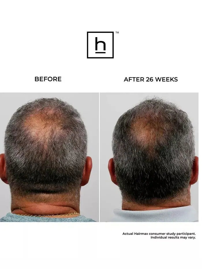 Лазерная расческа Hairmax Ultima 12 для роста волос — изображение 7 из 7