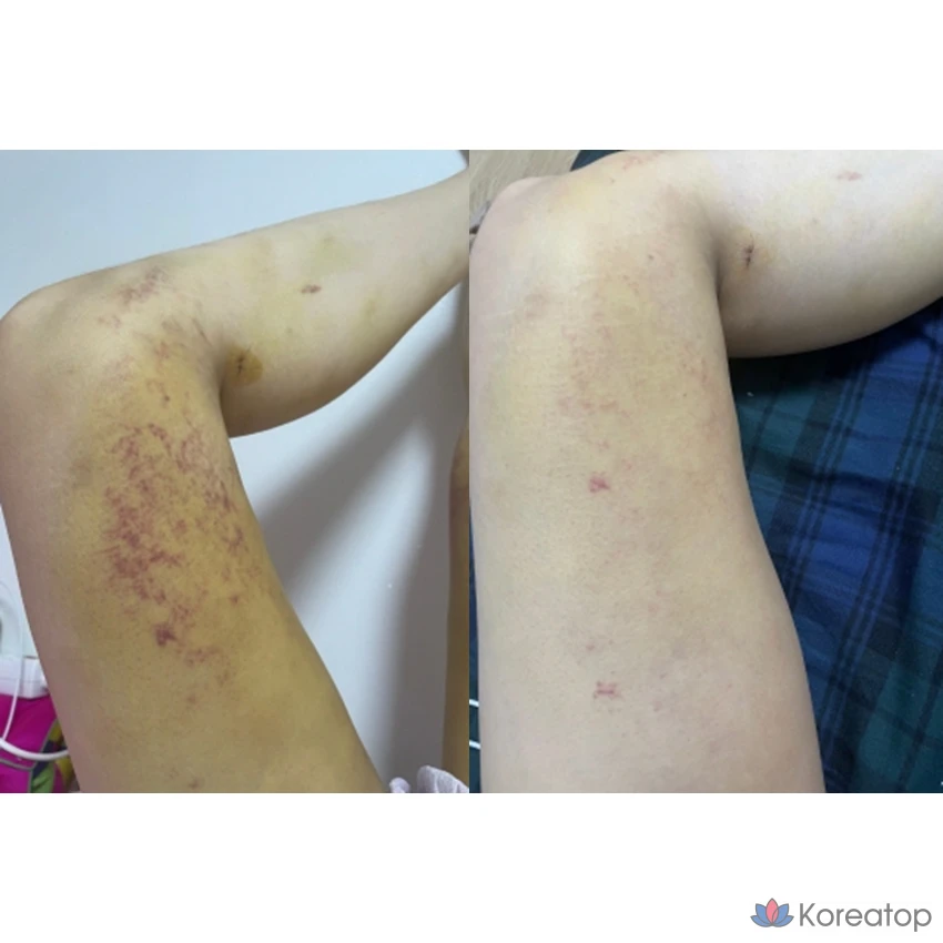 Крем ANACIS K-Oxyderm OP Inmode Bruise Vitamin K Cream, 15 мл, 2 шт.