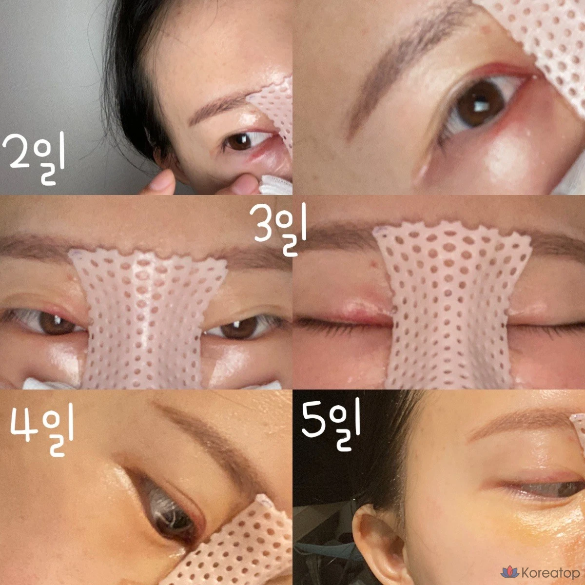 Крем ANACIS K-Oxyderm OP Inmode Bruise Vitamin K Cream, 15 мл, 2 шт.