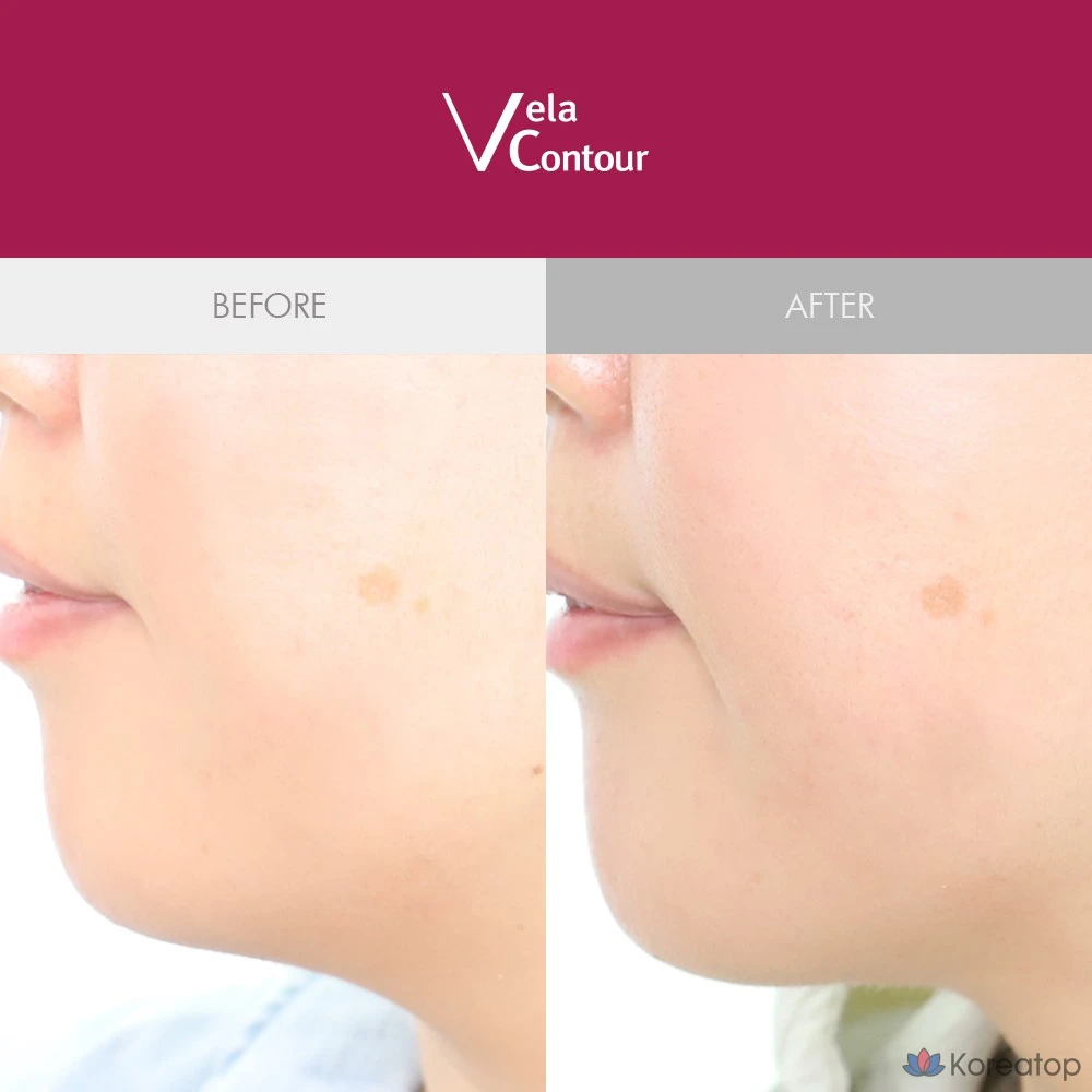 Ампульная сыворотка ANACIS Bella Contour Botox Deep Ball Lifting Ampoule, 30 мл, 50.5 г, 1 шт.