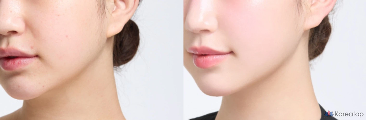 Крем-тональная основа HANSKIN Blemish Cover Comfort Cream Foundation, оттенок Cream Beige, 30 мл, 1 шт.